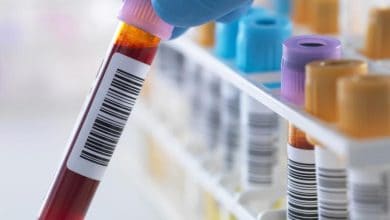 اكتشاف اختبار دم جديد لرصد سرطان المبيض في مراحله الأولى بدقة عالية