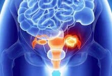 دواء تجريبي يضاعف تقريبًا فرص نجاة مريضات سرطان المبيض