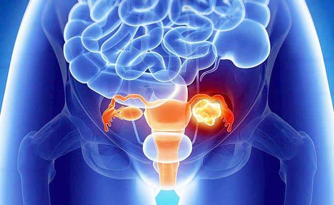 دواء تجريبي يضاعف تقريبًا فرص نجاة مريضات سرطان المبيض 32 دواء تجريبي يضاعف تقريبًا فرص نجاة مريضات سرطان المبيض