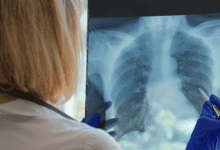 السل في المغرب: 53% من الحالات المسجلة سنة 2025 خارج الرئتين