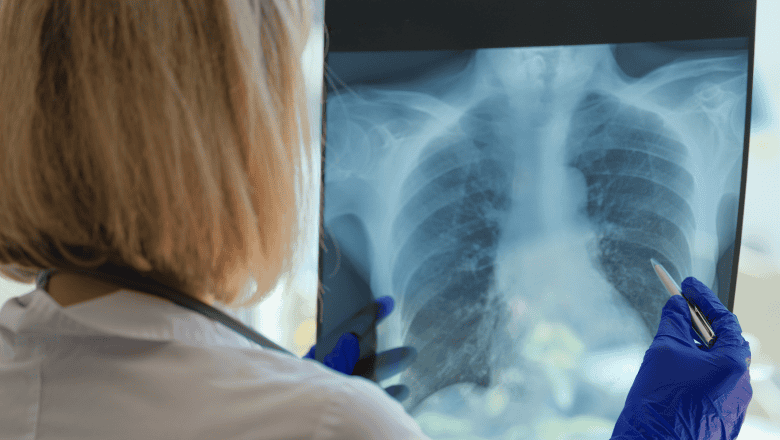 السل في المغرب: 53% من الحالات المسجلة سنة 2025 خارج الرئتين